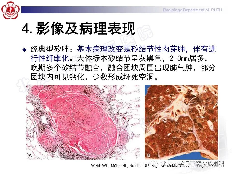影像PPT - 【PPT】矽肺-15