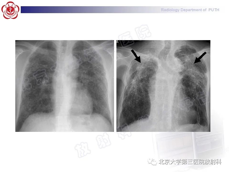 影像PPT - 【PPT】矽肺-19