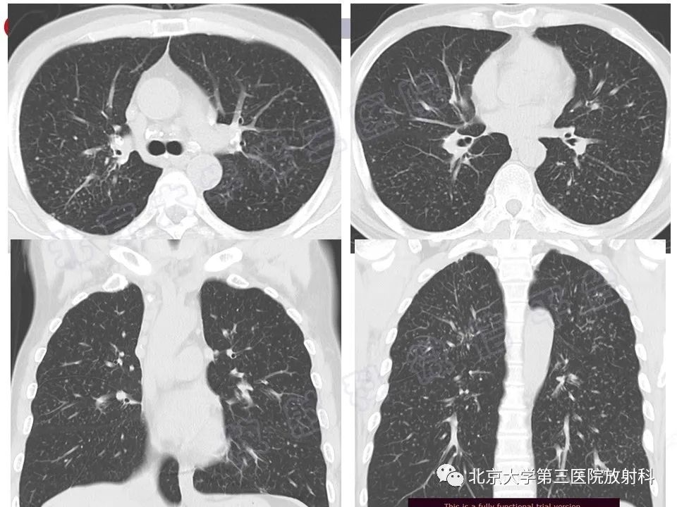 影像PPT - 【PPT】矽肺-20