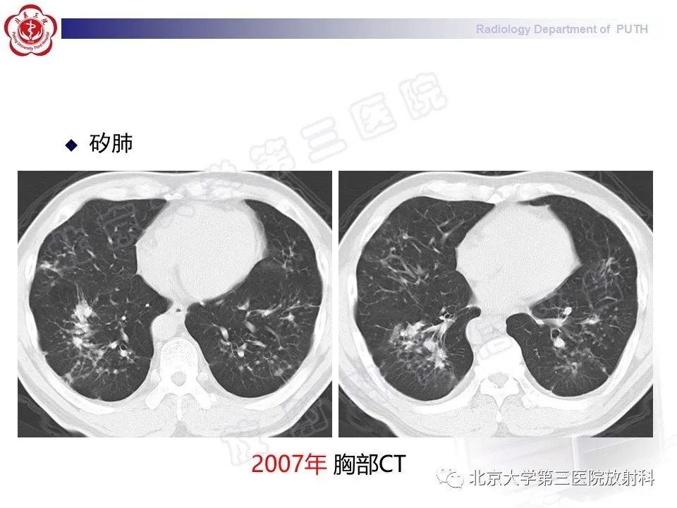 影像PPT - 【PPT】矽肺-22