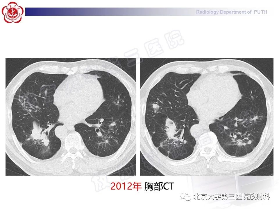 影像PPT - 【PPT】矽肺-23