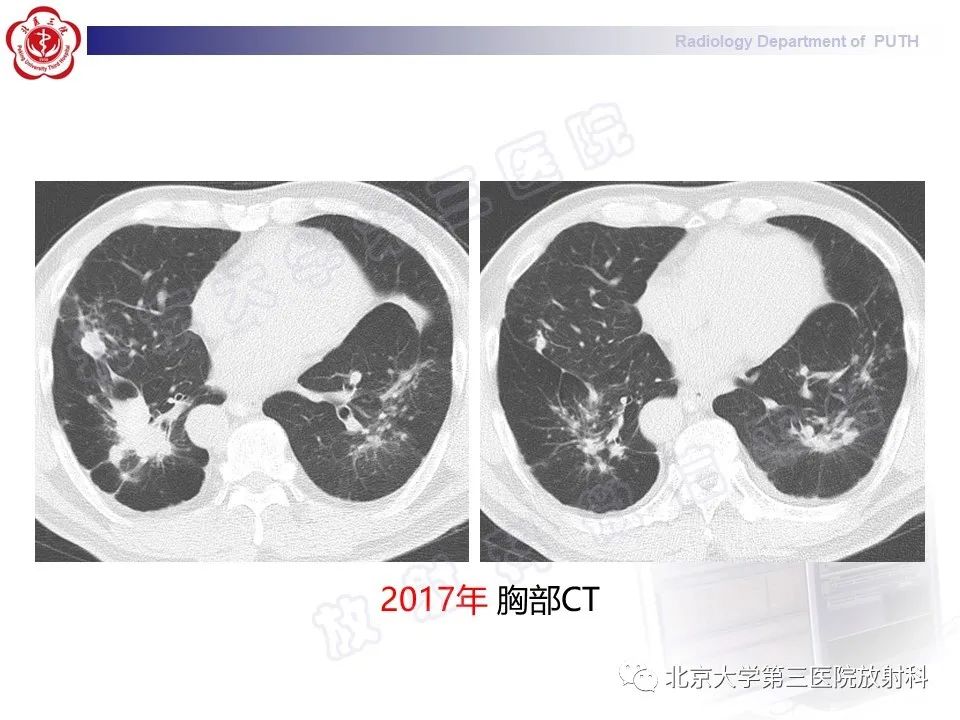 影像PPT - 【PPT】矽肺-24