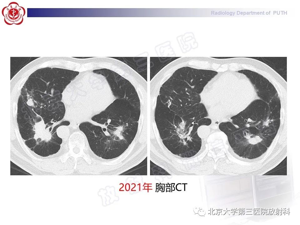 影像PPT - 【PPT】矽肺-25