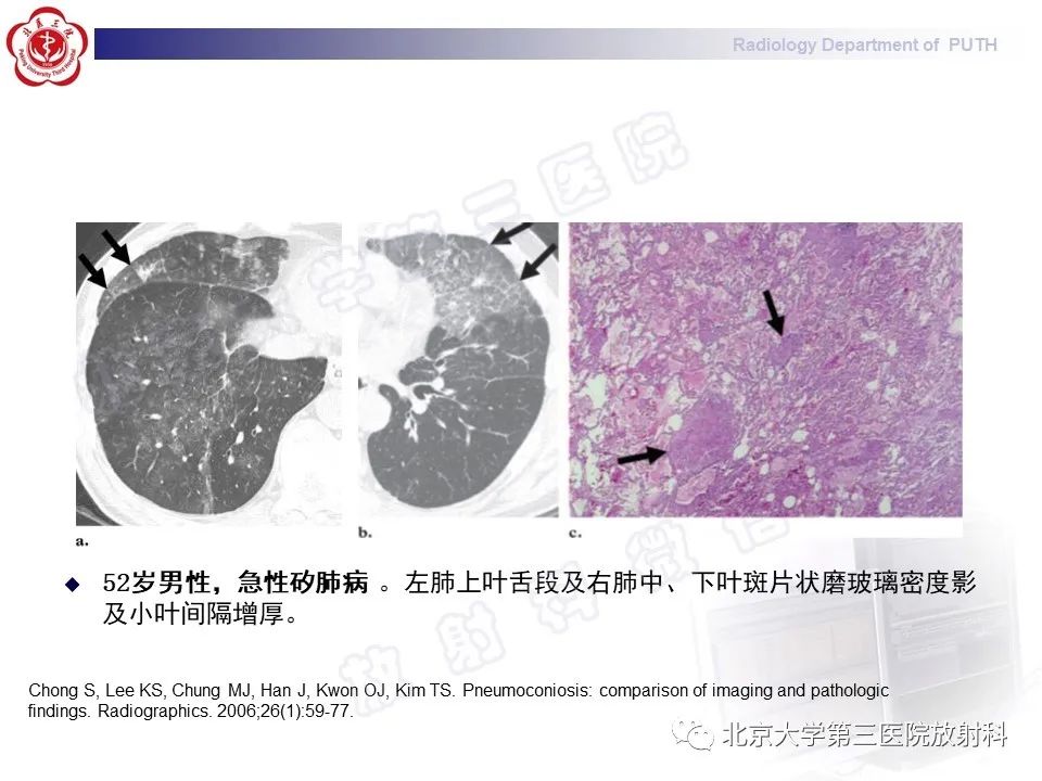 影像PPT - 【PPT】矽肺-27