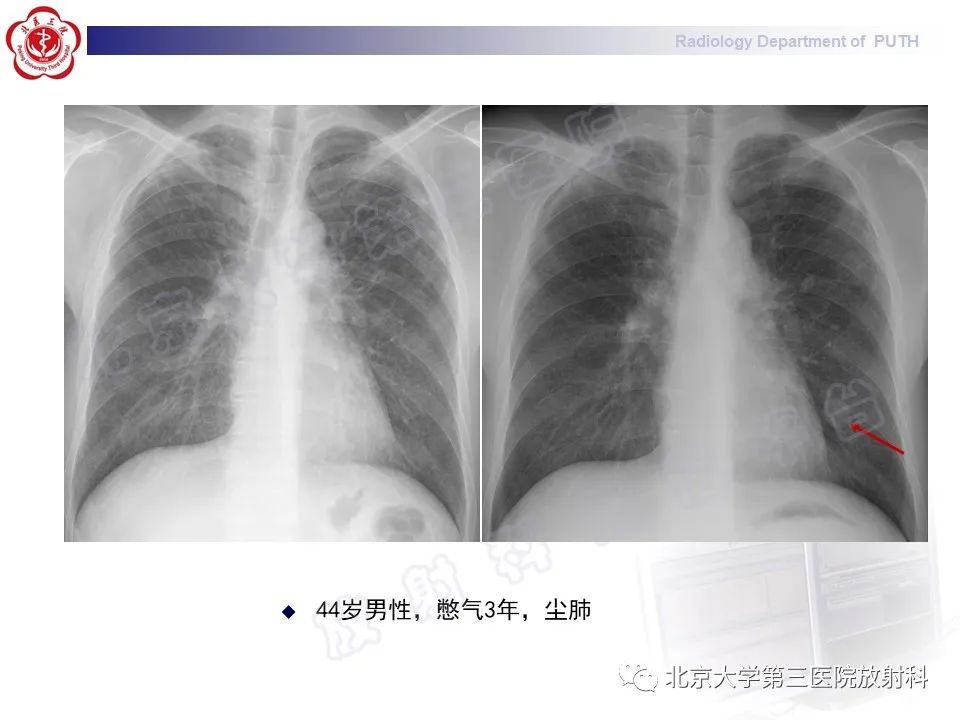 影像PPT - 【PPT】矽肺-31