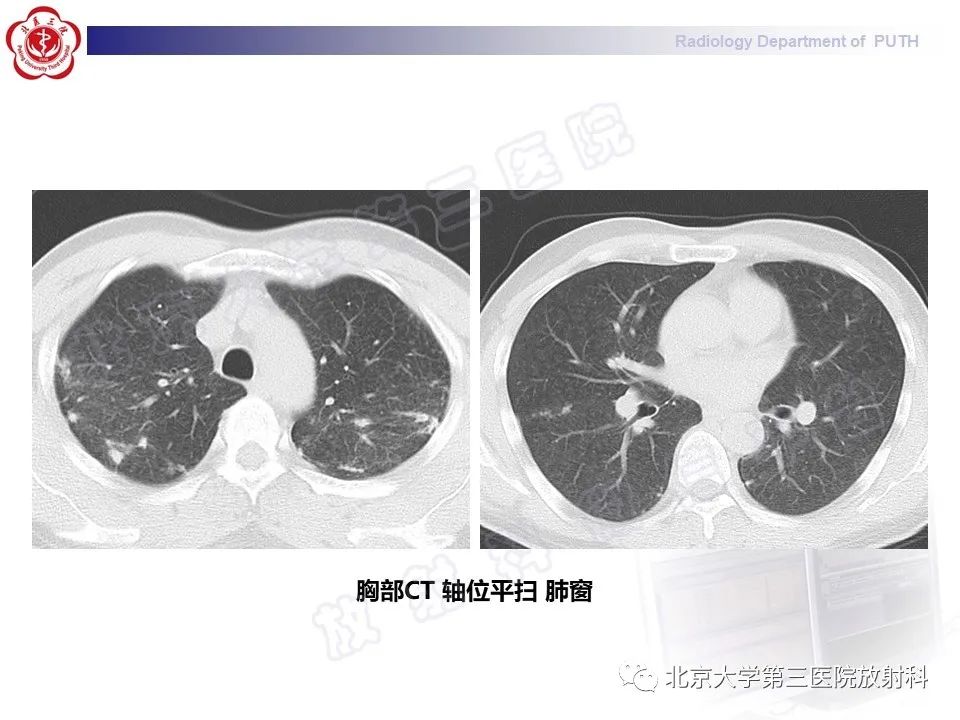 影像PPT - 【PPT】矽肺-32