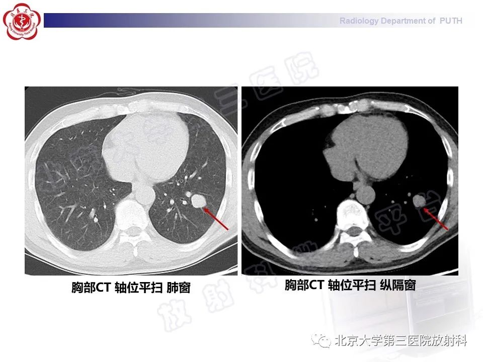 影像PPT - 【PPT】矽肺-33