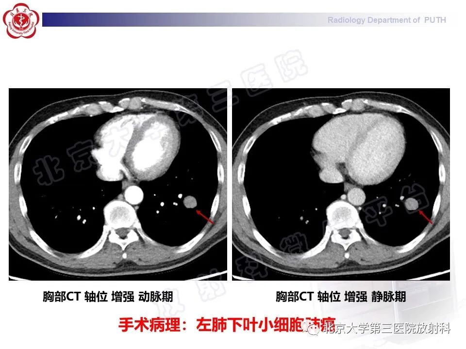 影像PPT - 【PPT】矽肺-34
