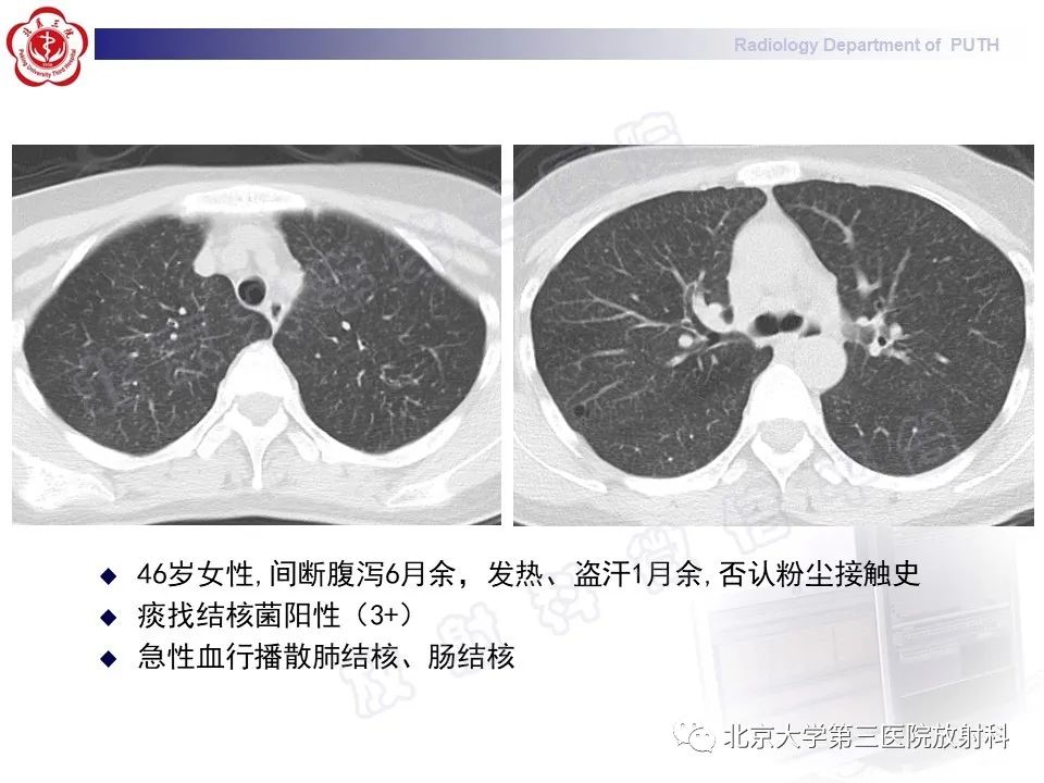 影像PPT - 【PPT】矽肺-37