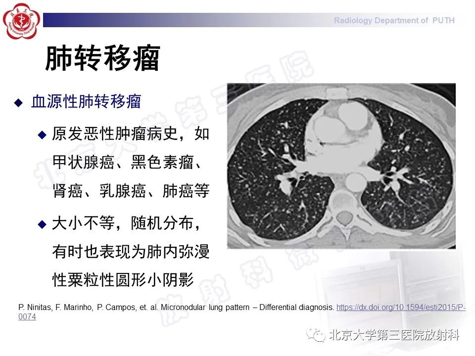 影像PPT - 【PPT】矽肺-40
