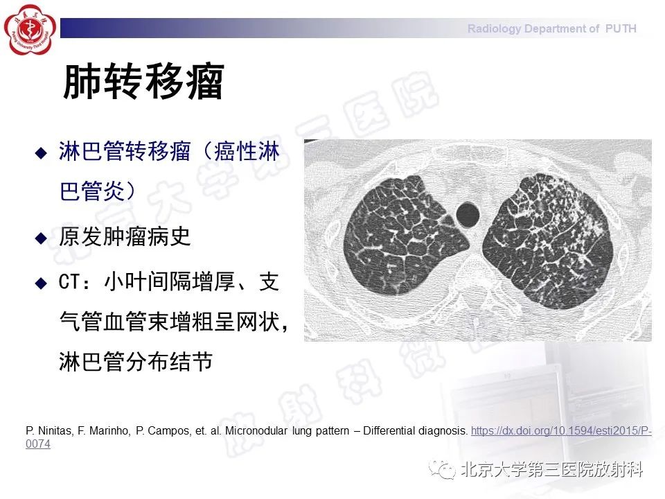 影像PPT - 【PPT】矽肺-41