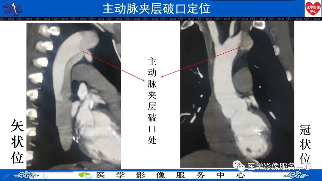 影像PPT - 【PPT】CTA诊断主动脉夹层的内容和征象-5