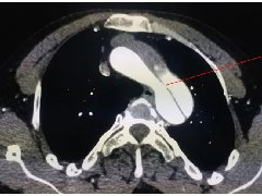 影像PPT - 【PPT】CTA诊断主动脉夹层的内容和征象-4