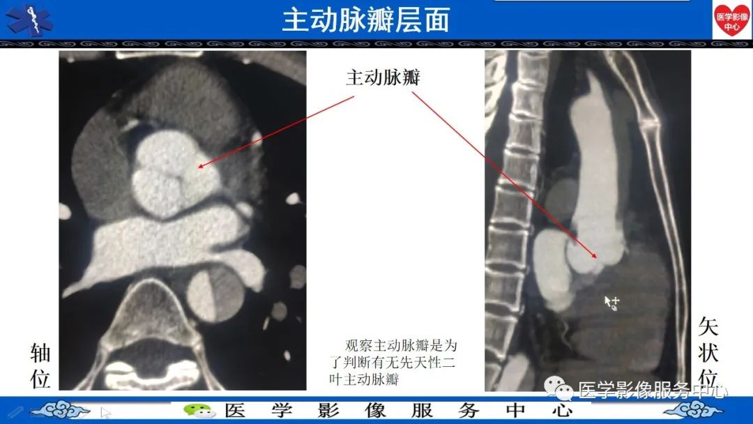 影像PPT - 【PPT】CTA诊断主动脉夹层的内容和征象-6