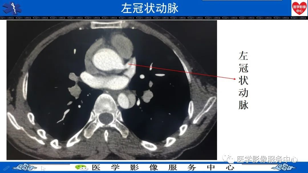 影像PPT - 【PPT】CTA诊断主动脉夹层的内容和征象-8