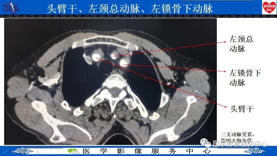 影像PPT - 【PPT】CTA诊断主动脉夹层的内容和征象-9
