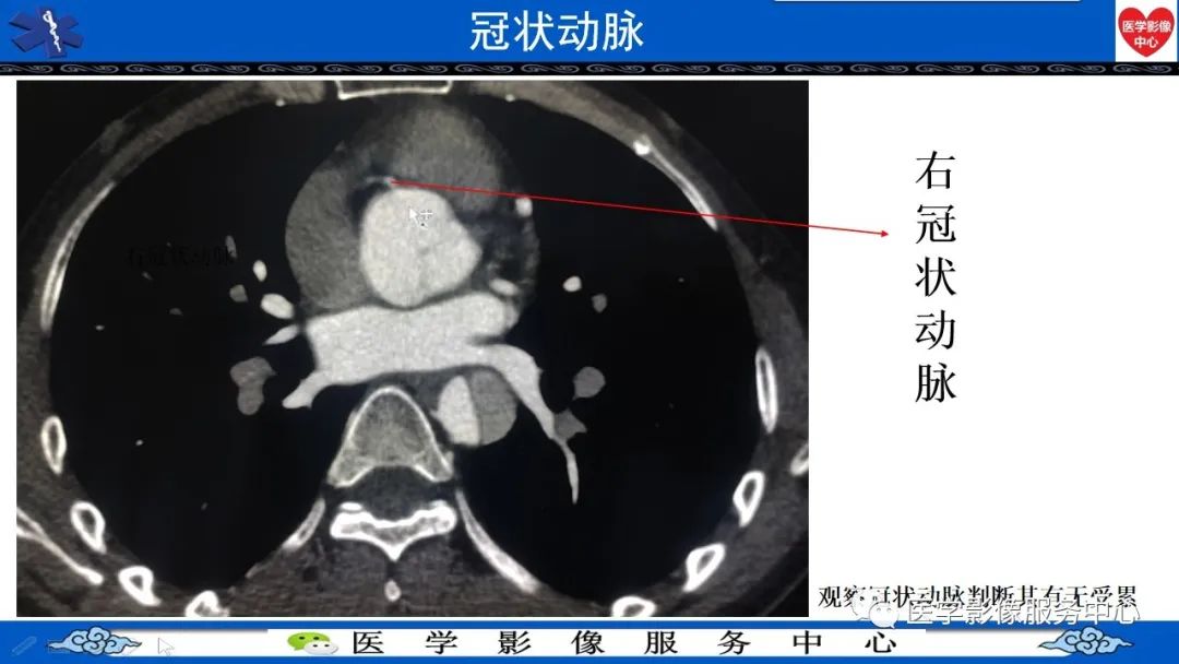 影像PPT - 【PPT】CTA诊断主动脉夹层的内容和征象-7