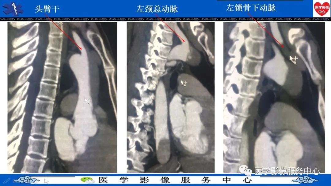 影像PPT - 【PPT】CTA诊断主动脉夹层的内容和征象-10