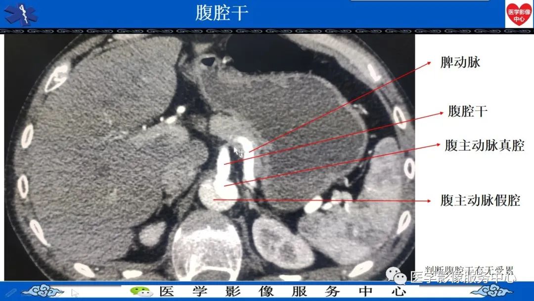 影像PPT - 【PPT】CTA诊断主动脉夹层的内容和征象-11