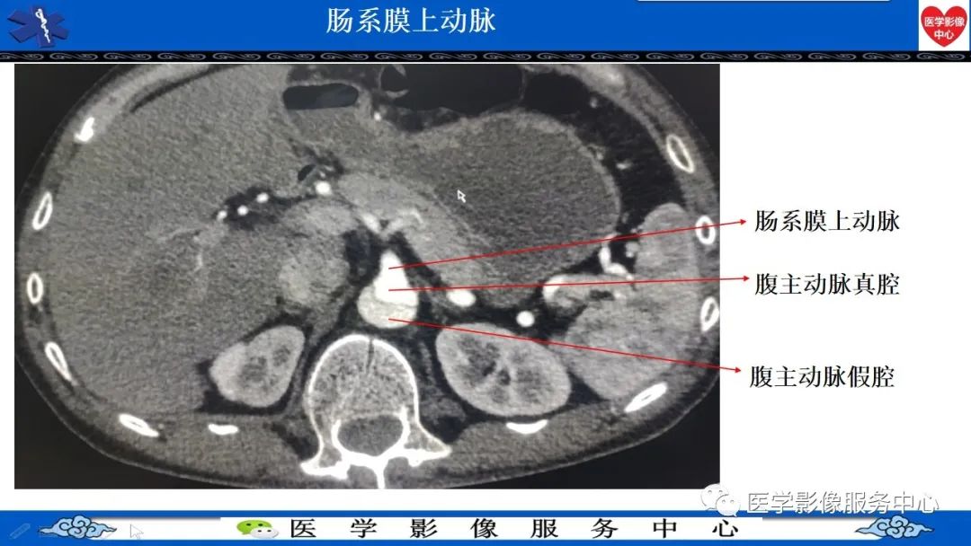影像PPT - 【PPT】CTA诊断主动脉夹层的内容和征象-12