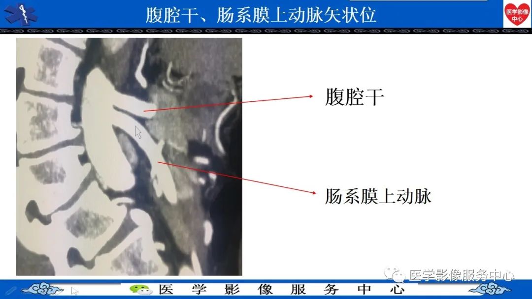 影像PPT - 【PPT】CTA诊断主动脉夹层的内容和征象-13