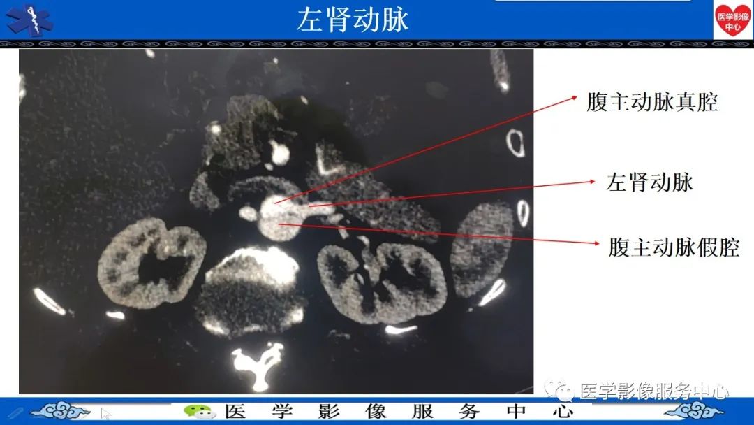 影像PPT - 【PPT】CTA诊断主动脉夹层的内容和征象-14