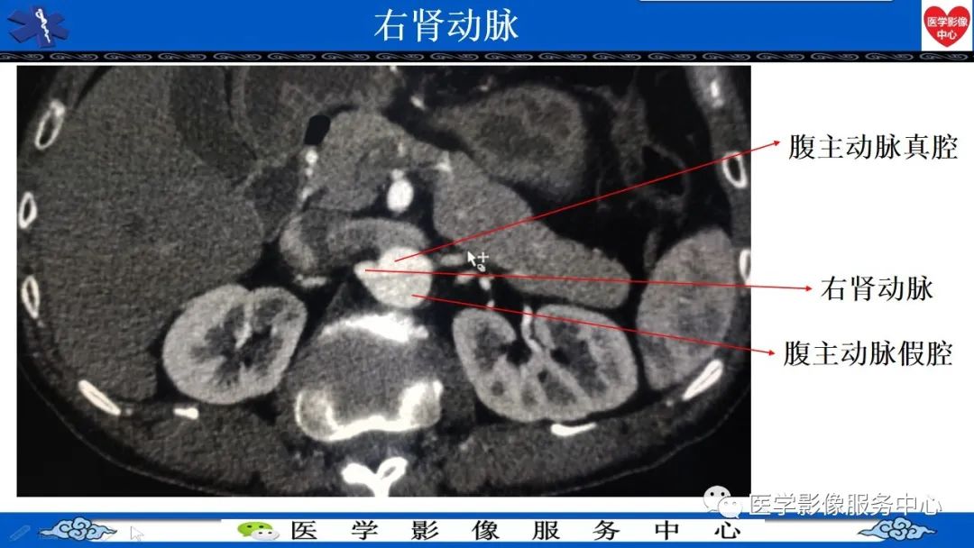 影像PPT - 【PPT】CTA诊断主动脉夹层的内容和征象-15