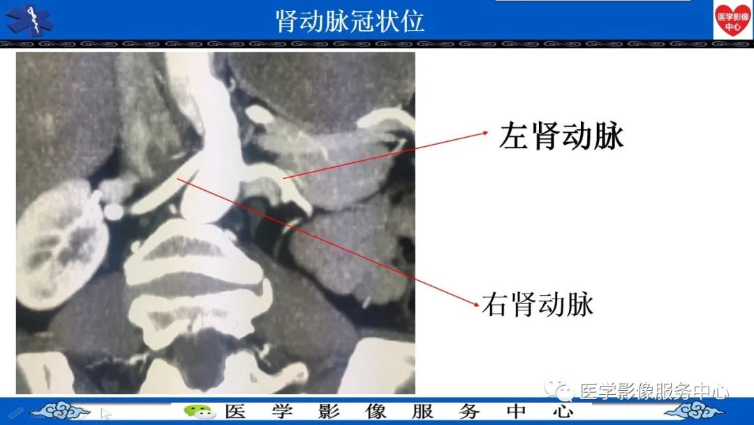 影像PPT - 【PPT】CTA诊断主动脉夹层的内容和征象-16