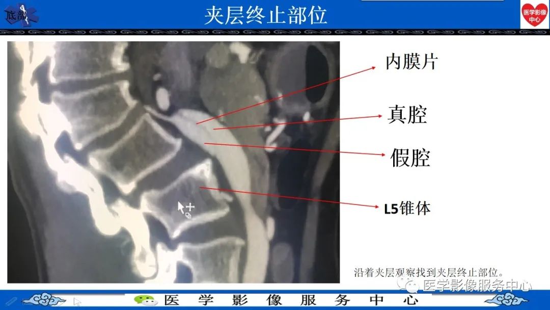 影像PPT - 【PPT】CTA诊断主动脉夹层的内容和征象-17