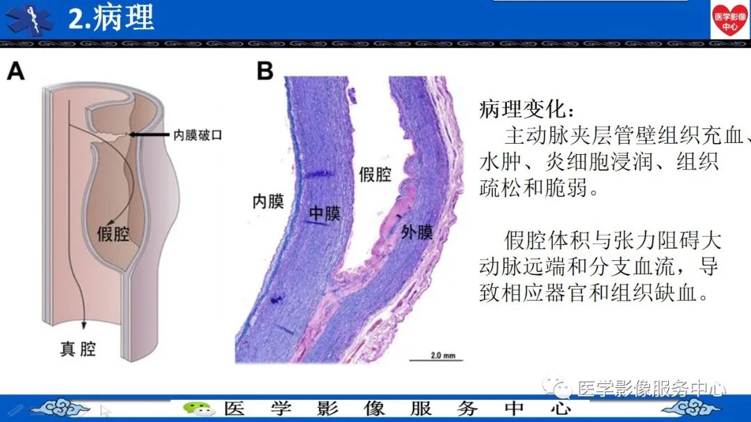影像PPT - 【PPT】CTA诊断主动脉夹层的内容和征象-20
