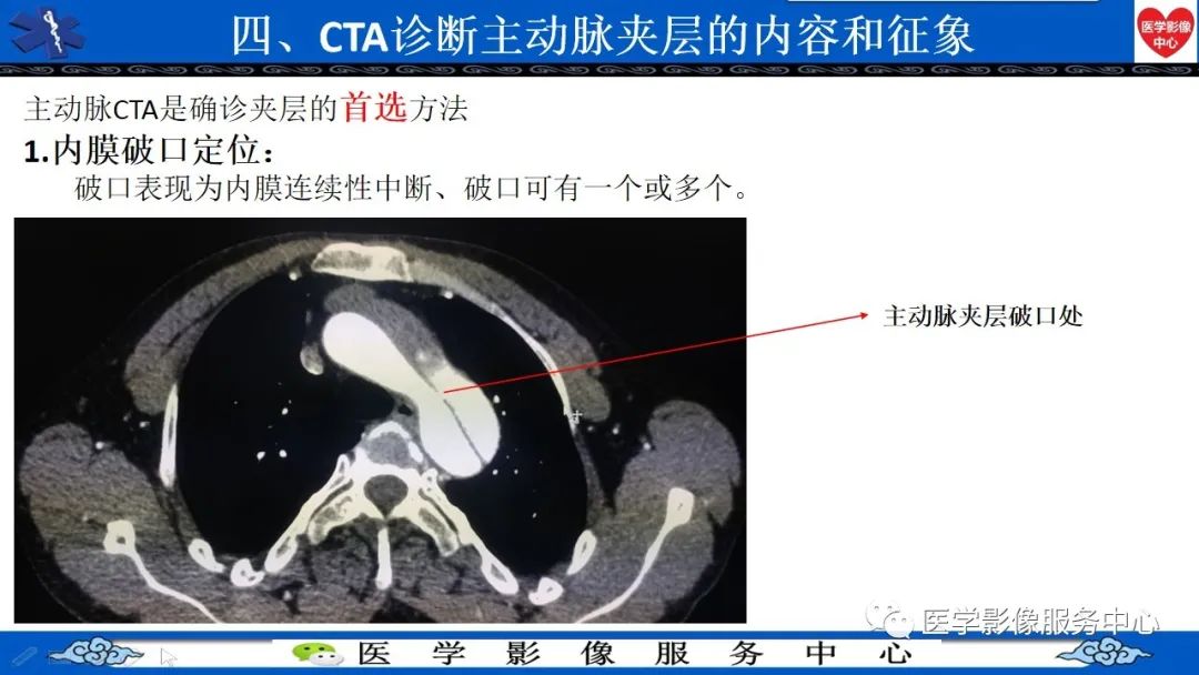 影像PPT - 【PPT】CTA诊断主动脉夹层的内容和征象-23