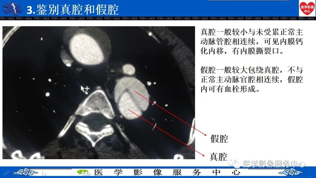 影像PPT - 【PPT】CTA诊断主动脉夹层的内容和征象-25