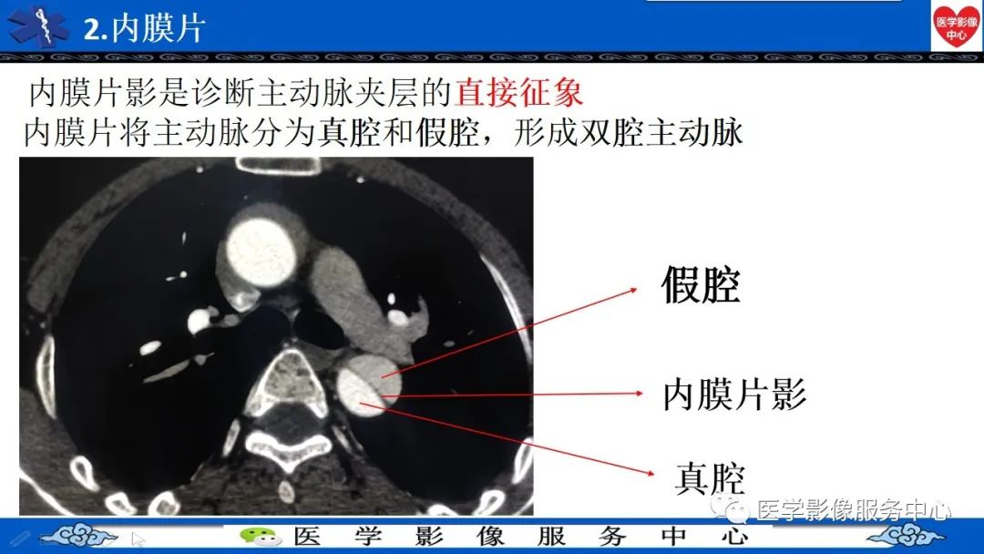 影像PPT - 【PPT】CTA诊断主动脉夹层的内容和征象-24