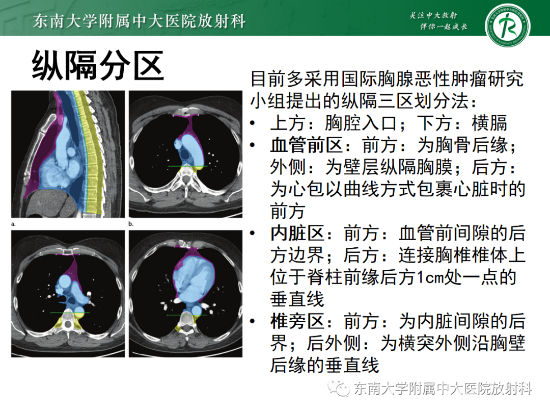 影像PPT - 【PPT】前纵隔胸腺瘤-6