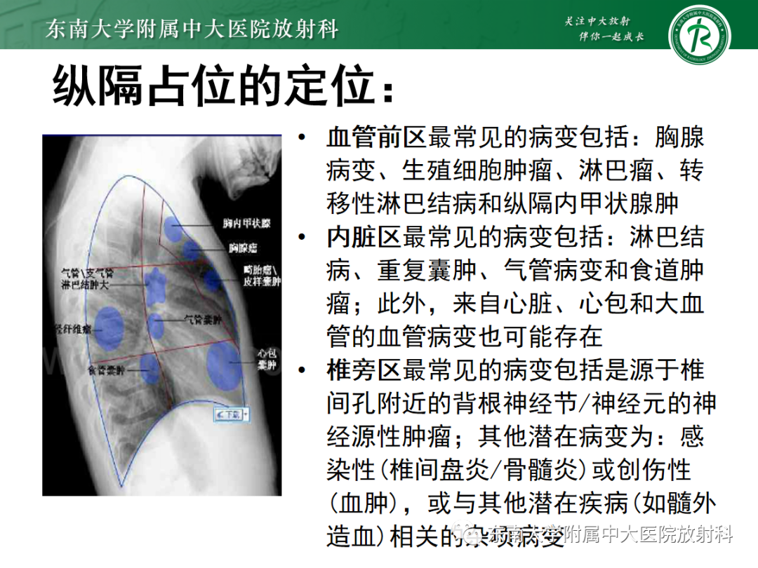 影像PPT - 【PPT】前纵隔胸腺瘤-7