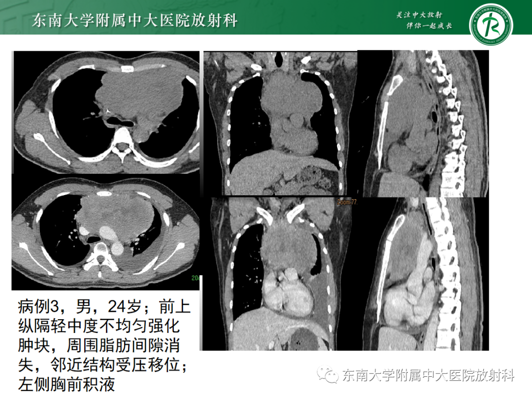 影像PPT - 【PPT】前纵隔胸腺瘤-18