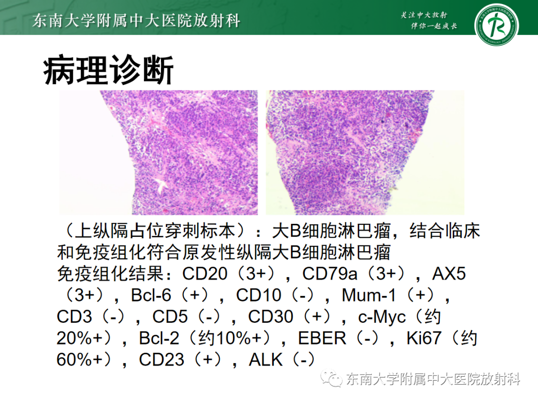 影像PPT - 【PPT】前纵隔胸腺瘤-19