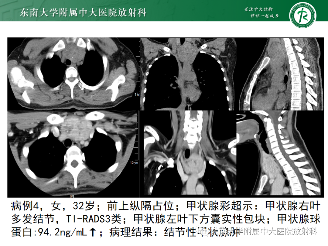 影像PPT - 【PPT】前纵隔胸腺瘤-23