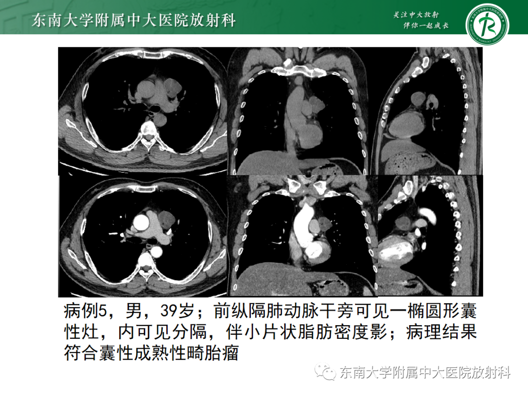 影像PPT - 【PPT】前纵隔胸腺瘤-26