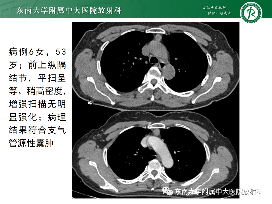 影像PPT - 【PPT】前纵隔胸腺瘤-29