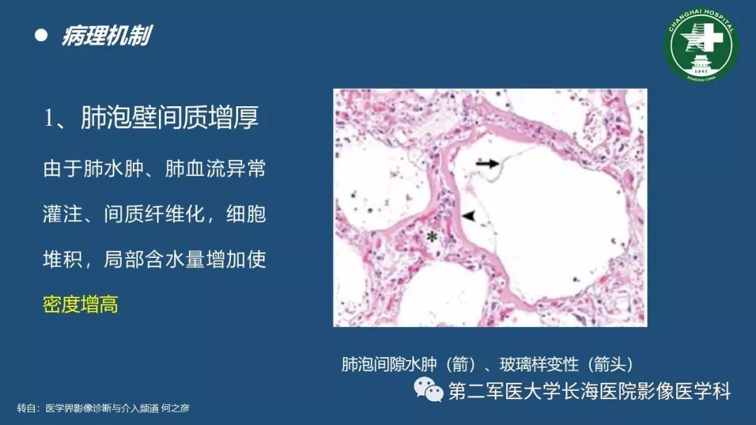 影像PPT - 【PPT】肺磨玻璃密度影的诊断及鉴别-5