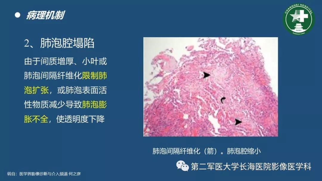 影像PPT - 【PPT】肺磨玻璃密度影的诊断及鉴别-6