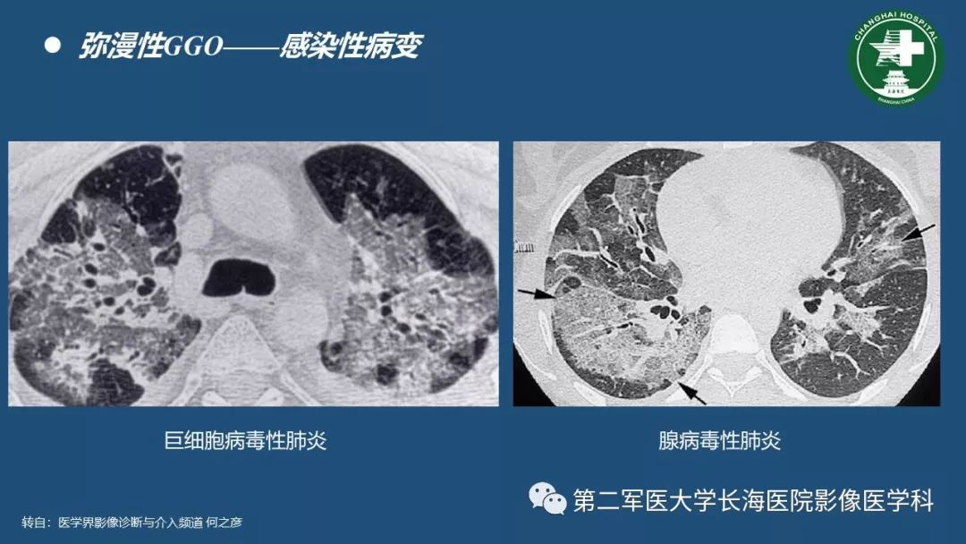 影像PPT - 【PPT】肺磨玻璃密度影的诊断及鉴别-9