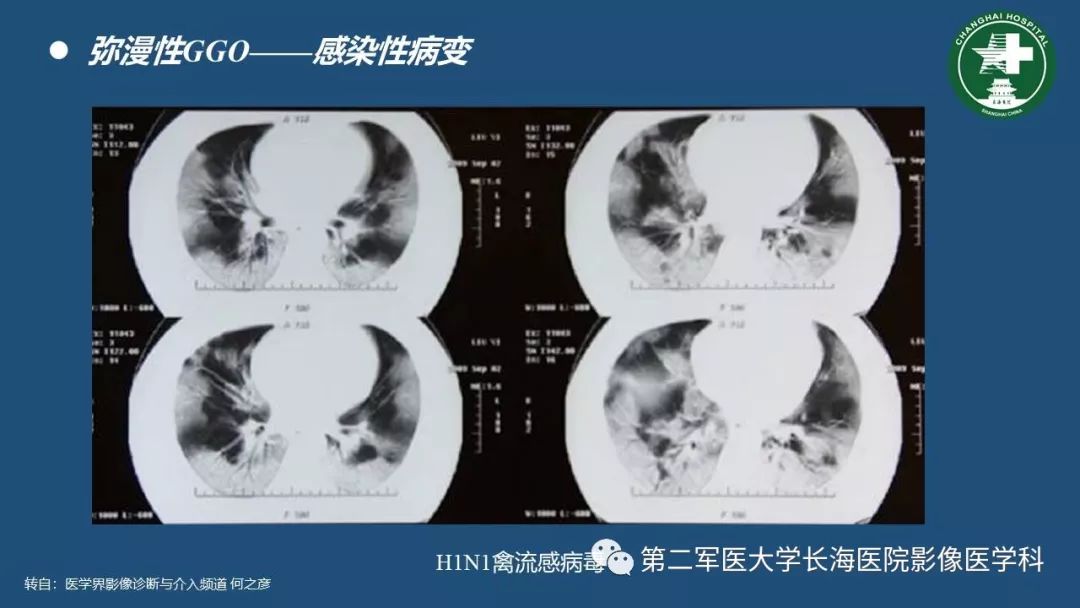 影像PPT - 【PPT】肺磨玻璃密度影的诊断及鉴别-10