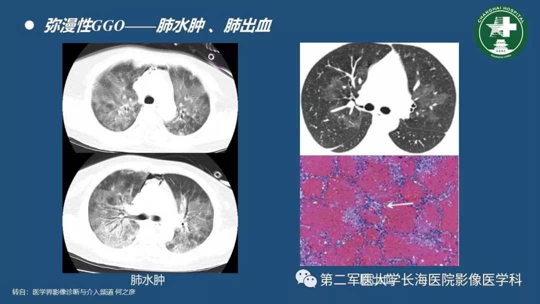 影像PPT - 【PPT】肺磨玻璃密度影的诊断及鉴别-11