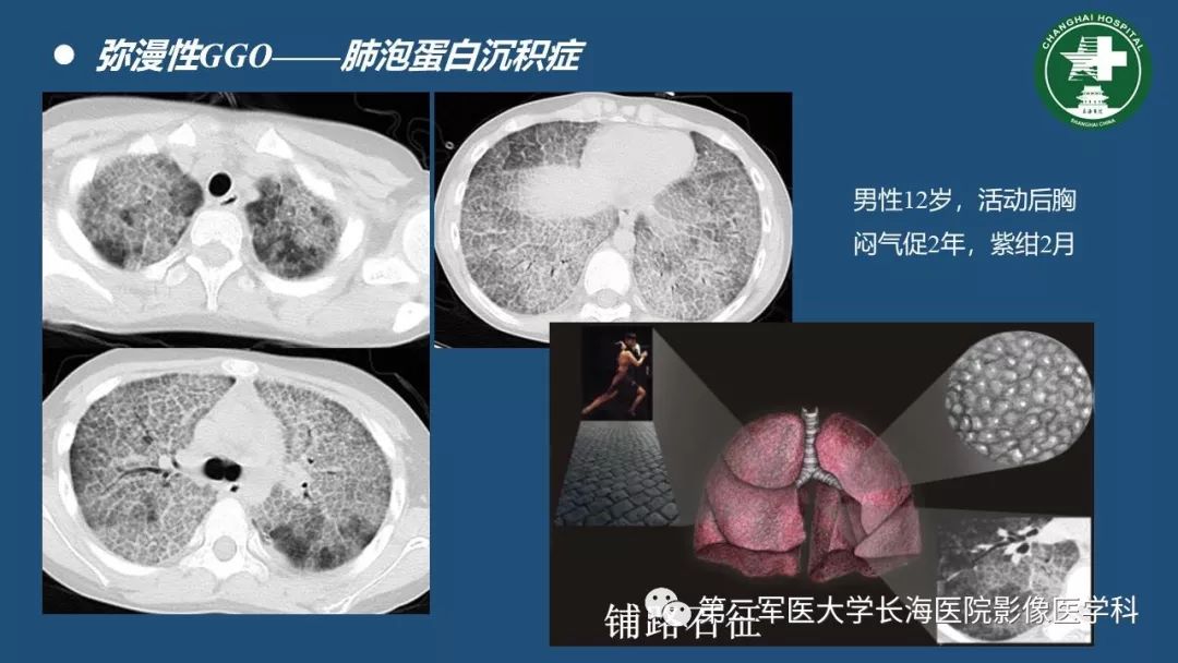 影像PPT - 【PPT】肺磨玻璃密度影的诊断及鉴别-13