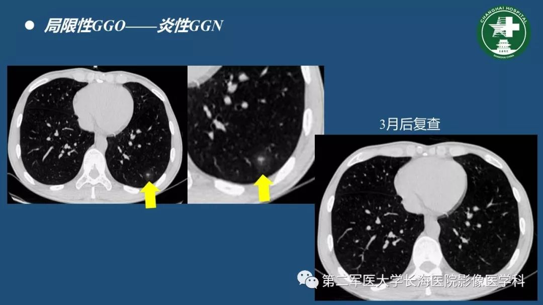 影像PPT - 【PPT】肺磨玻璃密度影的诊断及鉴别-15