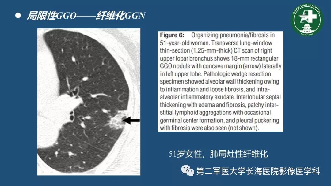 影像PPT - 【PPT】肺磨玻璃密度影的诊断及鉴别-16