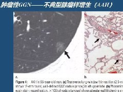 肺磨玻璃密度影的诊断及鉴别