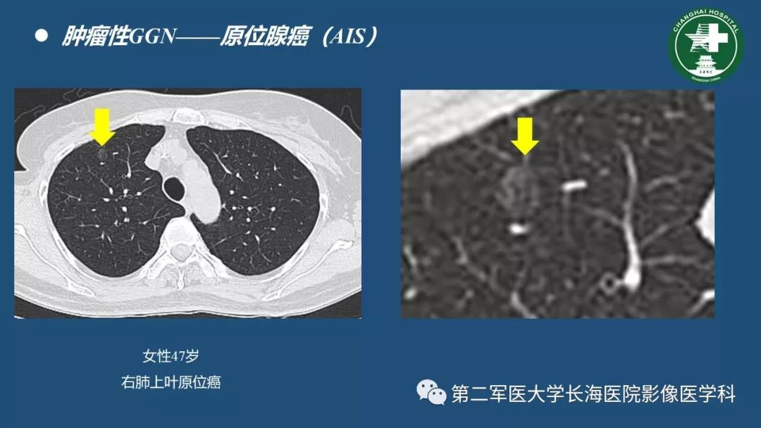 影像PPT - 【PPT】肺磨玻璃密度影的诊断及鉴别-24